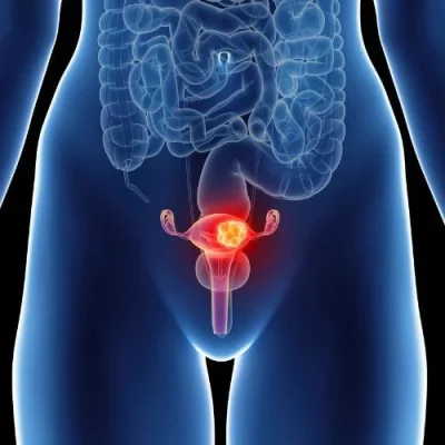 Polycystic ovary syndrome